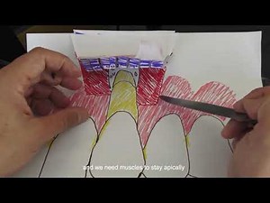 schematic explanation of the surgical technique of the coronally advanced flap