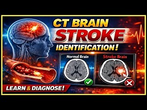 How to Identify Stroke on CT Brain | Stroke Medical Animation | Ischemic vs Hemorrhagic