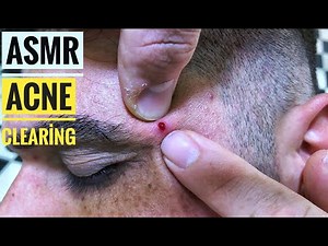 ASMR MASSAGE • Asmr Acne removal Session and Eyebrow Correctio