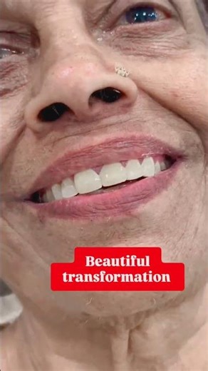 #doctor #dentist #dentalprosthesis #dentalclinic #dentaltretment # zirconiacrown
