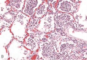 causes of chronic inflammation?