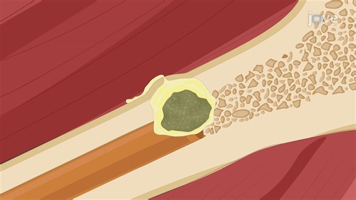 Bacterial Bone Infection Model in Rabbits | JoVE EoE