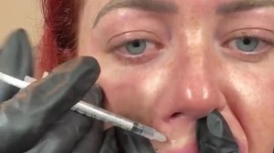 I filled my whole face with Botox myself - people can’t believe I didn’t flinch