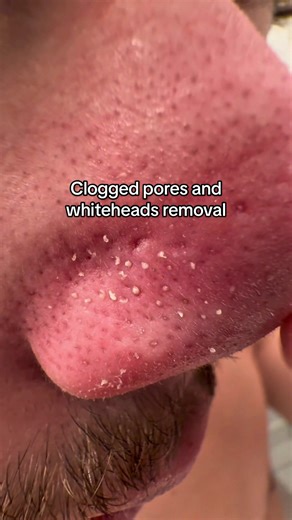 Effective Techniques for Clogged Pores Removal