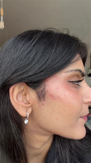 Let’s normalise NORMAL skin 👏👏👏 #acne #skincare #dermatology