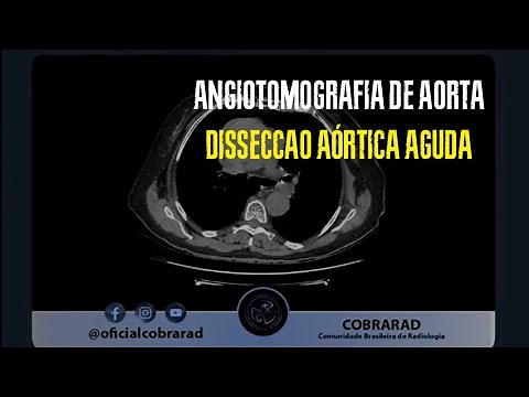 Angiotomografia de Aorta |Dissecção Aórtica Aguda.