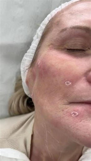 Profhilo #skincareroutine #baby #ttc