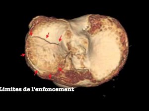 Genou-Fracture-plateau-tibial-TDM-3D