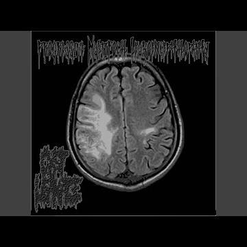Progressive Multifocal Leukoencephalopathy