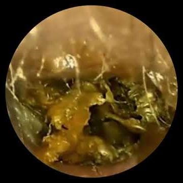Explore Ear View | Satisfying Earwax Removal & Ear Cleaning Close Up