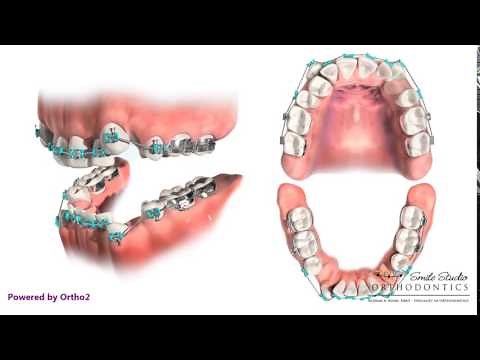 Orthodontic Treatment - Extraction of First Premolars
