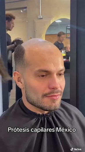 Prótesis Capilares: Recupera Tu Confianza en México