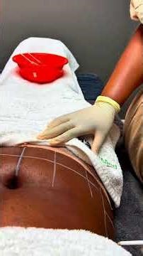 Lets do a belly surgery BBL