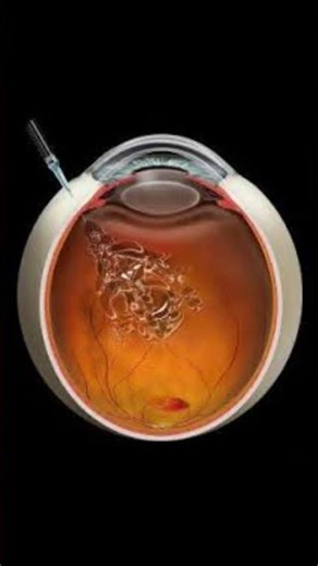 Is Avastin a good treatment for diabetic macular edema?