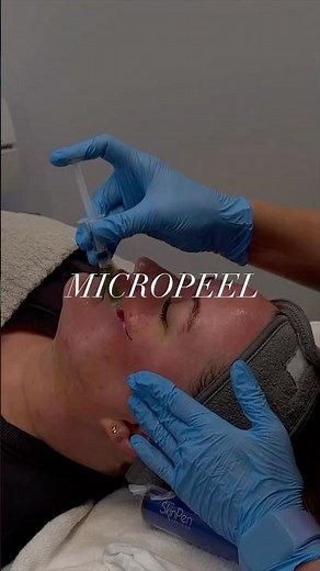 MicroPeel | Prep your skin for laser season with our Microneedling + BioRePeel combination treatment