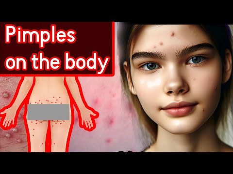 Folliculitis 101: Understanding Bumpy Skin: Causes, treatment and prevention