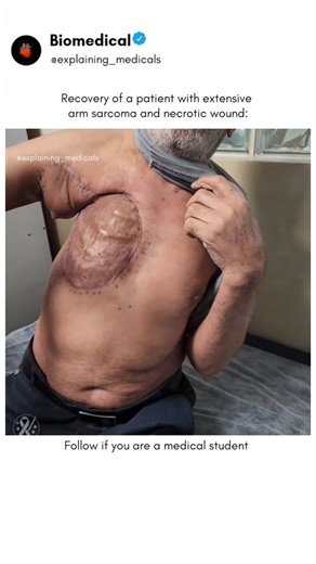 Explaining Medicals on Instagram: "Follow @explaining_medicals ⬇️⬇️⬇️⬇️ What text books can't show you, We animate. Complete resection was performed, including removal of the involved nerves followed by nerve grafting. A vascular graft was also placed, and the affected area was reconstructed using a pectoral flap. . . . . . 📝 | Hard Concepts, Simplified in 30 Seconds 📚 | Tired Of Dense Books, Watch And Learn 💡 | Visualizing The invisible in 3D For educational purposes only. Dm for credit or r