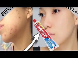 Quick Face whitening with Toothpaste, Rang Gora Toothpaste Face Mask /Remove Pimples/Dark spots