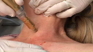 Microneedling with Platelet Rich Plasma is an excellent option to treat skin that tolerates wounds poorly and scars easily. This treatment is almost painless and is extremely safe for delicate areas like the neck and chest. Call (815) 741-4343 for a consultation. | Premier Dermatology
