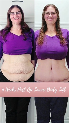 1K views · 60 reactions | Here is a scar/incision update with a look at how the wound area is doing. I have a new area on my backside I need to keep an eye on. My surgeon isn't too concerned about it though. I'm STILL swolle and this can last for months! #plasticsurgery #lowerbodylift #looseskin #excessskinremoval #excessskin | Thenicolechronicles | Facebook