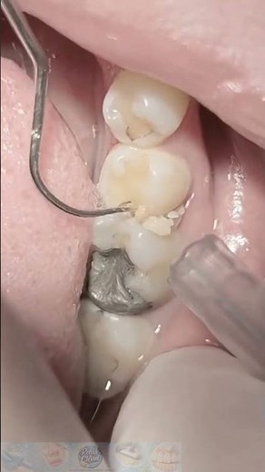 Deep Teeth Scaling & Stain Removal
