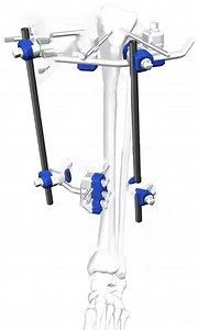 [Hot Item] Orthopedic Surgical Instruments Femoral External Fixator