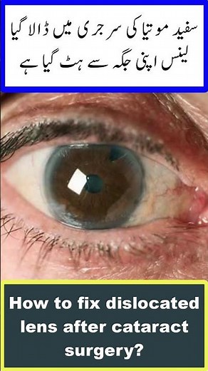 How to fix dislocated lens after cataract surgery? | Safed Motia