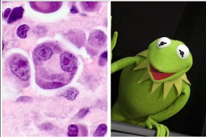 Identifica la célula de Reed-Sternberg