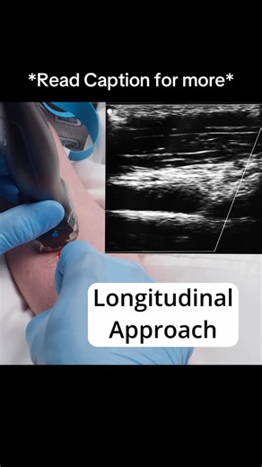 Brian “The IV Guy” on Instagram: "This is a longitudinal view on ultrasound and it’s one of my FAVORITE things 😁. In this view you can see the entire needle and catheter enter the vein. This reduces the chance of going through the opposite wall, and gives you the option to capture images and measure catheter length within the vessel for charting. . First, find a vein in the transverse Plane and make sure you know where all nearby structures are. Once you’ve prepped your site and are ready to po