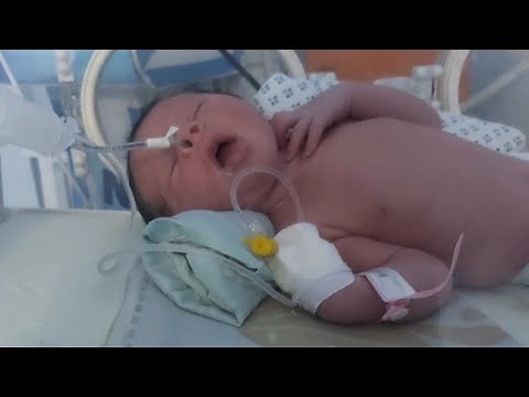 Subtle seizure(sucking, lip 💋 smacking, chewing,protruding tongue👅cycling movement)common full-term
