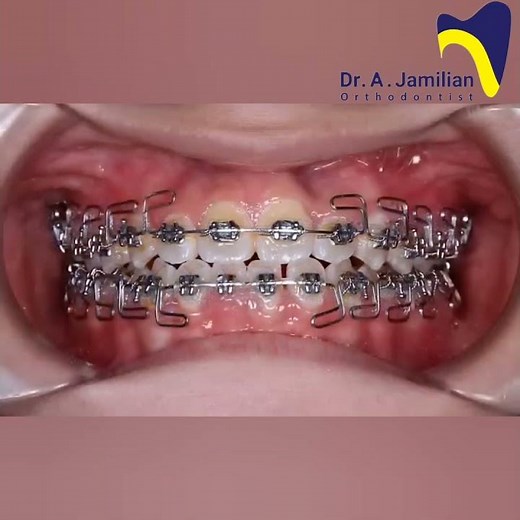 Fixed Orthodontics Before & After | Braces, Amazing Results #dentist #orthodontics #braces #smile