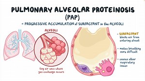 Video: Pulmonary Alveolar Proteinosis, PAP (NORD) - Video Explanation! | Osmosis | Osmosis