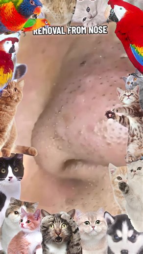 "Deep Blackhead Extraction! So Satisfying! 😍✨" #BlackheadRemoval #Dee... | blackhead