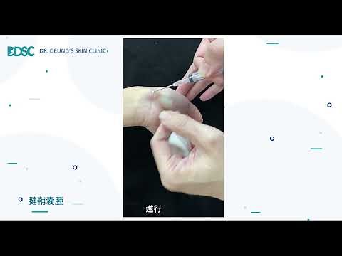皮膚醫學 -良性腫瘤-【腱鞘囊腫】ganglion cyst