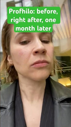 Profhilo Before & After — Realistic Results