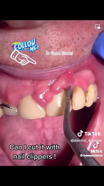Teeth Clipping with Nail Clipper Incident Explained