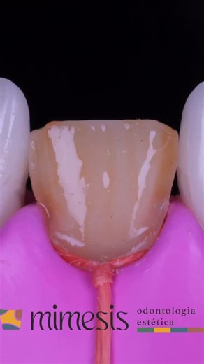 DENTISTRY SCIENCE on Instagram: "By fabisfsiqueira Working on a dark tooth is always a challenge - but with knowledge and excellent materials, everything flows. - First, we build the palatine shell with Elora’s Trans resin, ensuring the ideal translucent base. Next, we neutralize the darkened background with Assist APS Opaquer - Universal color. Then we move on to the body layers and enamel: DA1 for dentin and WE (proximity and vestibular) to deliver shine, naturalness and a balanced play of lig