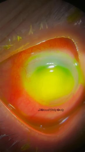 Mohamed Fathy on Instagram: "Corneal Abscess #ophthalmologylife #ophthalmologypearls #ophthalmologyresidency #ophthalmologyresidents #ophthalmology #ophthalmologyfuture #ophthalmologyclinic #ophthalmologystudent #ophthalmologyrocks #ophthalmologylovers #americanacademyofophthalmology #ophthalmicphotography #ophthalmicsurgeon #ophthalmicsurgery #ophthalmologist#eyesurgeon #slitlampphotography #oftalmologia #oftalmologista #ophthalmologyresident #ophthalmologytraining #ophthalmologydepartment #oph
