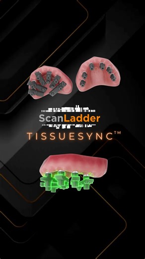 Scan Ladder on Instagram: "Scan Ladder vs Scan Ladder TissueSync - what’s the difference? 👇 In this video, we look at how the two systems are used within digital workflows. • TissueSync is designed to allow visibility of the soft tissue during scanning • Scan Ladder provides coverage across the tissue, depending on the workflow approach One shared feature across both systems is the use of cylindrical reference geometry, designed to work consistently across different intraoral scanners. Each sca