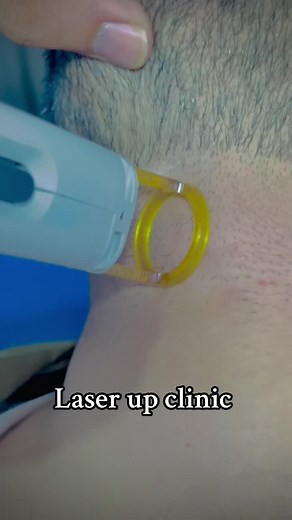 Laser Hair Removal Procedure: Close-Up Insights