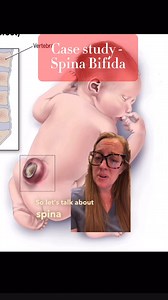 79K views · 886 reactions | Case study Spina Bifida Spina bifida is...