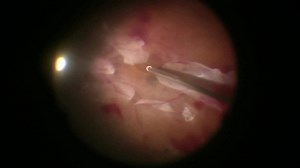 Unimanual 27-Gauge Vitrectomy for Tractional Retinal Detachment - Eyetube