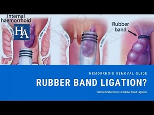 Hemorrhoidectomy vs Rubber Band Ligation Reviews - Recovery Time, Cost and Effectiveness