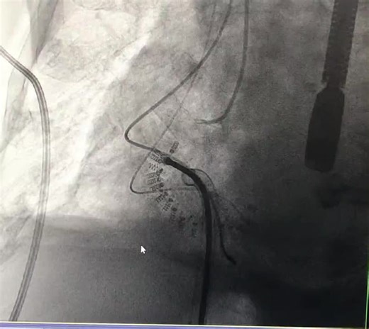 #edwards #cardioband #tricuspid #valve #reconstruction #system #reduce #repair #restore | Dr. Andi Rroku