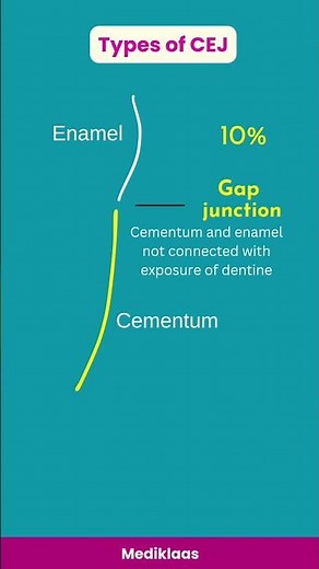 Cementoenamel junction types #cementum #enamel