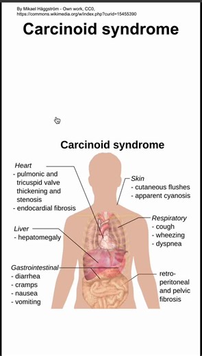 Carcinoid syndrome - youtube.com/@MedLecturesMadeEasy
