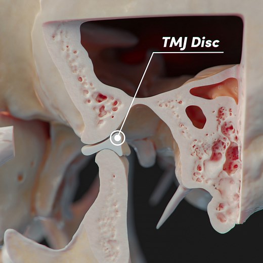 Anatomy.app on Instagram: "It's time to look at the temporomandibular joint (TMJ) and the articular disc. A unique feature of the TMJ is its articular disc - an elastic cartilage that serves as a cushion between the two bone surfaces (mandibular fossa of the temporal bone and condylar process of the mandible). Anteriorly the articular disc attaches to the lateral pterygoid muscle (a muscle of mastication) which pulls the disc out of the mandibular fossa during the opening of mouth. . . . . #anat