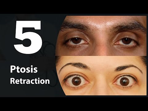 5- Eye lids (Ptosis & Retraction)