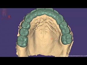 Exocad : Design perfect post and core bridge