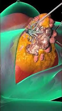 Mastectomy Breast Surgery (3D Animation)